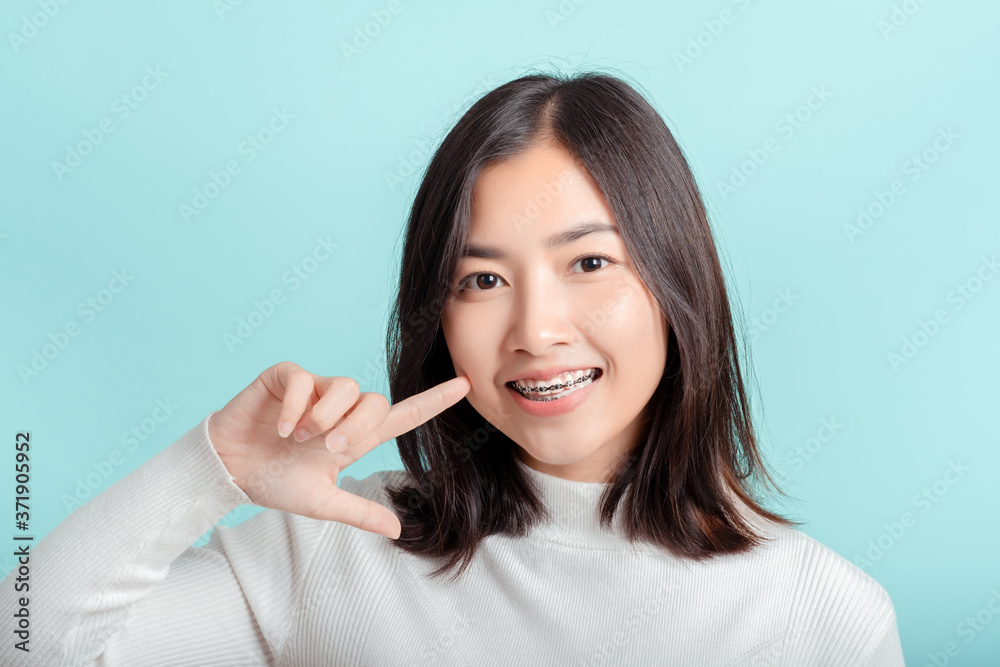 Dental braces of young asian woman wearing braces with white teeth concept. Dental braces of young asian woman wearing braces with white teeth concept.