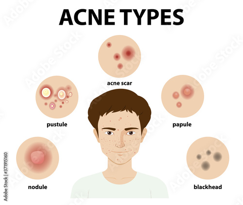Types of acne on the skin or pimples