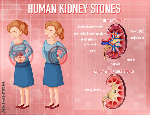 Comparison of healthy kidney and kidney with stones