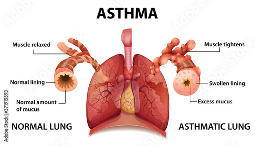 Human anatomy Asthma diagram