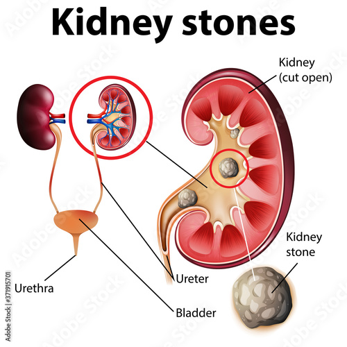 Informative illustration of kidney stones