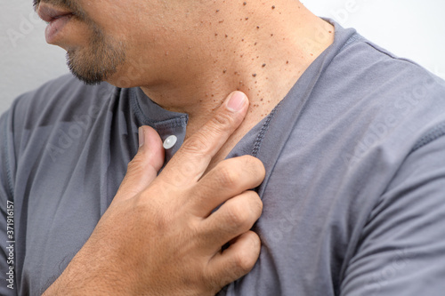 Closed up the Skin Tags or Acrochordon on neck man on white background. photo