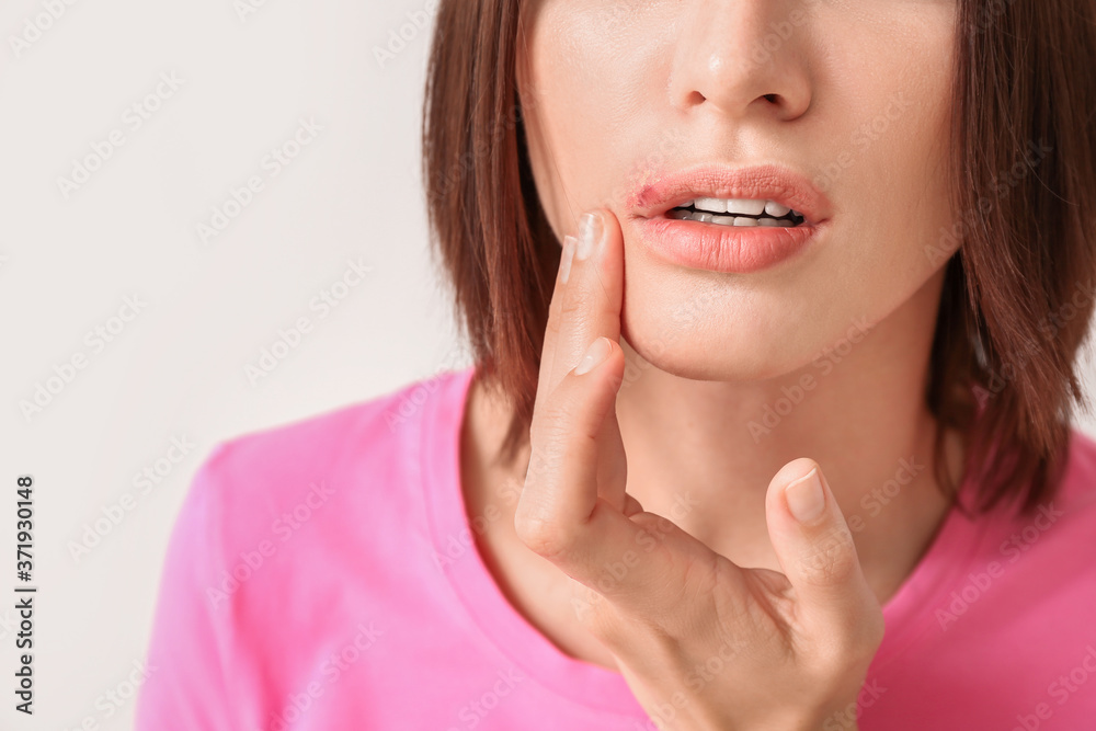 Young woman with cold sore on light background, closeup Young woman with cold sore on light background, closeup