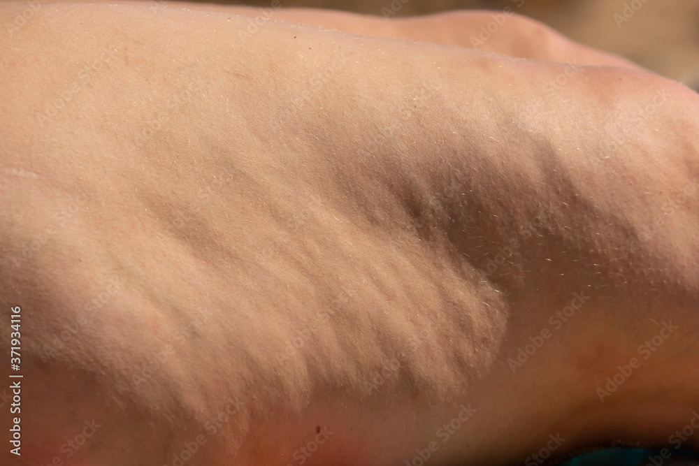cellulite on the female thigh as a background cellulite on the female thigh as a background