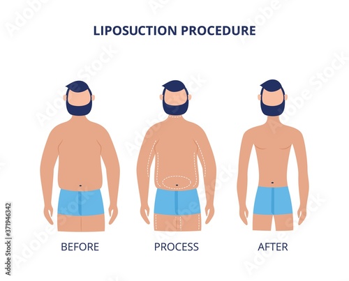 Liposuction procedure before and after - cartoon man during weight loss surgery