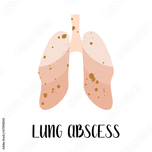 Lung abscess. Lungs disease. Pulmonology. Vector flat illustration. Perfect for flyer, medical brochure, banner, landing page, website