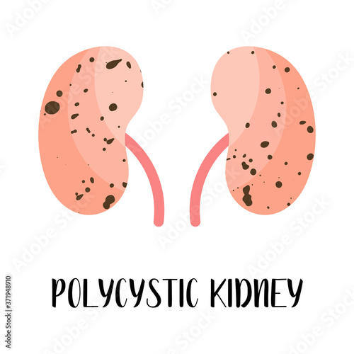 Polycystic kidney. Kidneys disease. Urology. Vector flat illustration. Perfect for flyer, medical brochure, banner, landing page, website
