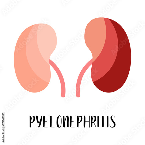 Pyelonephritis. Kidneys disease. Urology. Vector flat illustration. Perfect for flyer, medical brochure, banner, landing page, website