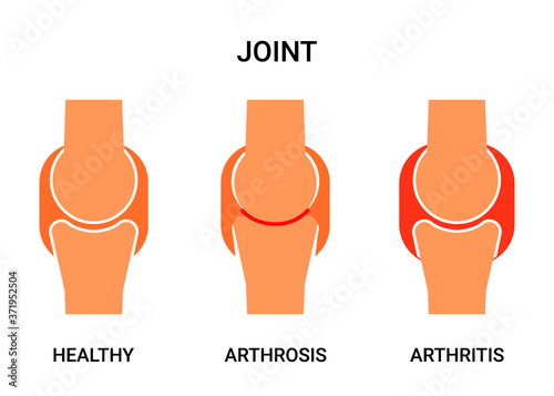 Human joint, healthy, atritis and arthrosis. Joint pain, abrasion of cartilage, inflammation of the joint capsule. Vector illustration