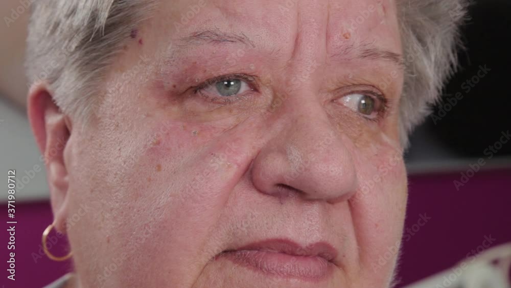Elderly woman with papillomas on her face at the medical center. Elderly woman with papillomas on her face at the medical center.