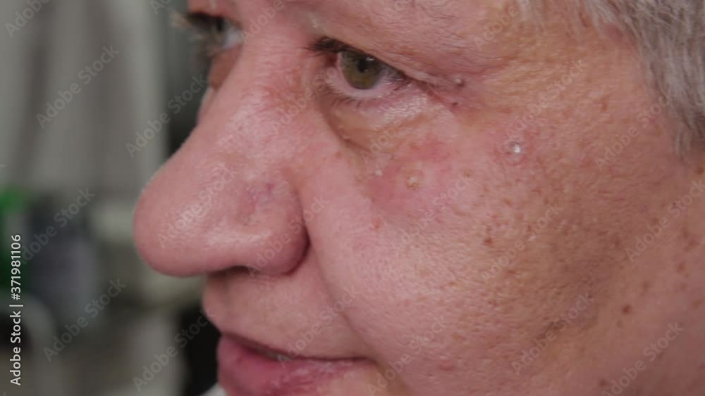 Elderly woman with papillomas on her face at the medical center. Elderly woman with papillomas on her face at the medical center.
