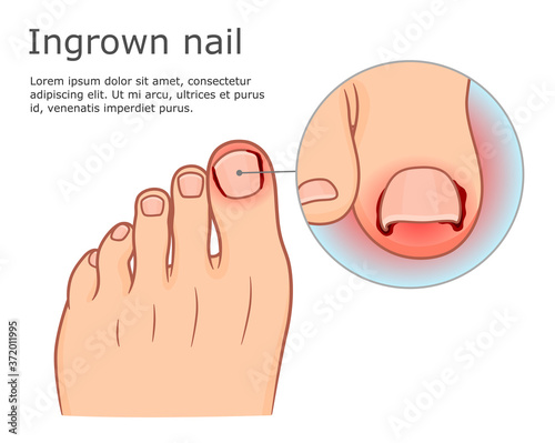 Ingrown nail disease medical infographic. Vector illustration.
