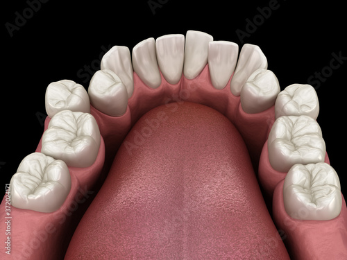 Abnormal teeth position, orthodontic concept. Medically accurate tooth 3D illustration