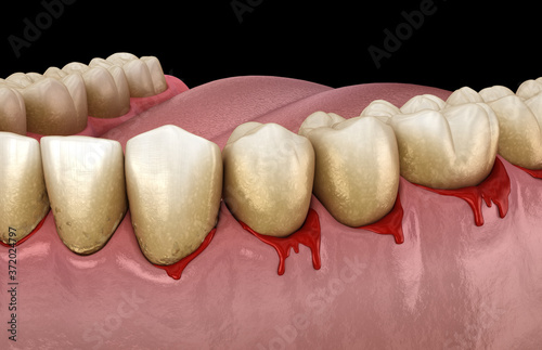 Bleeding gums or Periodontal - pathological inflammatory condition of the gum and bone support. Dental 3D illustration photo