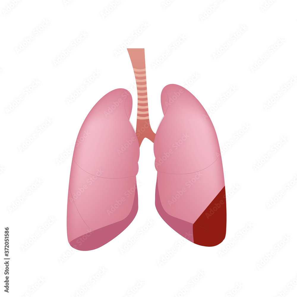 Human lungs, vector illustration, right lung inflammation