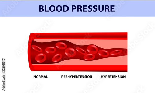 High blood pressure. Cross section of a blood vessel, medical illustration