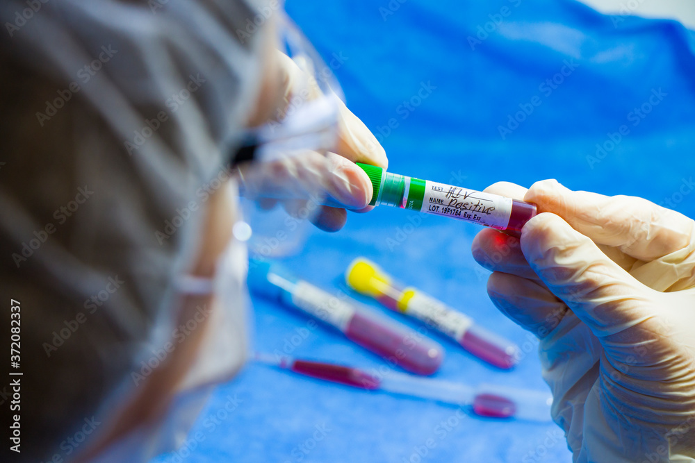 Hiv and aids infection test, doctors face and hand holding tube with blood on the blue background. Hiv and aids infection test, doctors face and hand holding tube with blood on the blue background.
