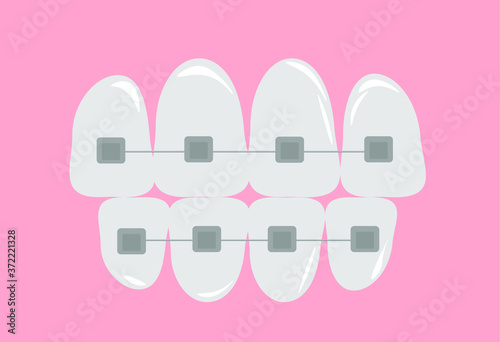 vector illustration orthodontic braces complex orthodontic fixed structures (devices) for correcting the position of human teeth in cases of malocclusion and unevenness of the dentition on an isolated