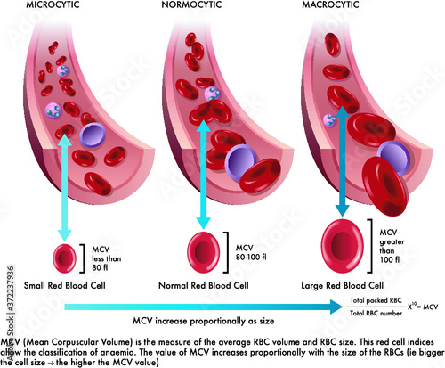 Medical illustration shows the difference between a normal red blood cell with one afflicted from microcytosis and another from macrocytosis, with annotations.