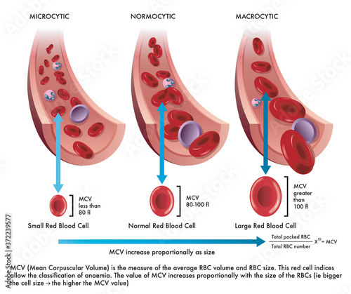 Medical illustration shows the difference between a normal red blood cell with one afflicted from microcytosis and another from macrocytosis, with annotations. photo