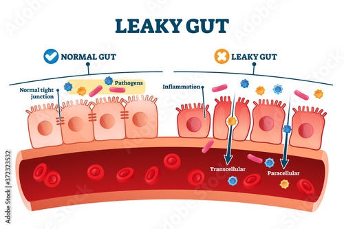 Leaky gut syndrome as medical chronic inflammation condition explanation