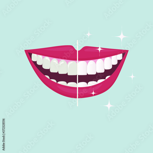 the smile of a man with his mouth wide open. Tooth whitening, tooth colour comparison before and after the procedure. Daily oral hygiene. poster for dental design. Flat illustration