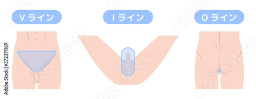 脱毛箇所　VIO　デリケートゾーン