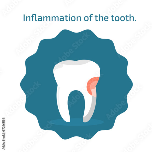 Inflammation on the tooth. Vector medical illustration of periodontitis disease. Dental flat icons on blue background. Vector illustration for dentistry.