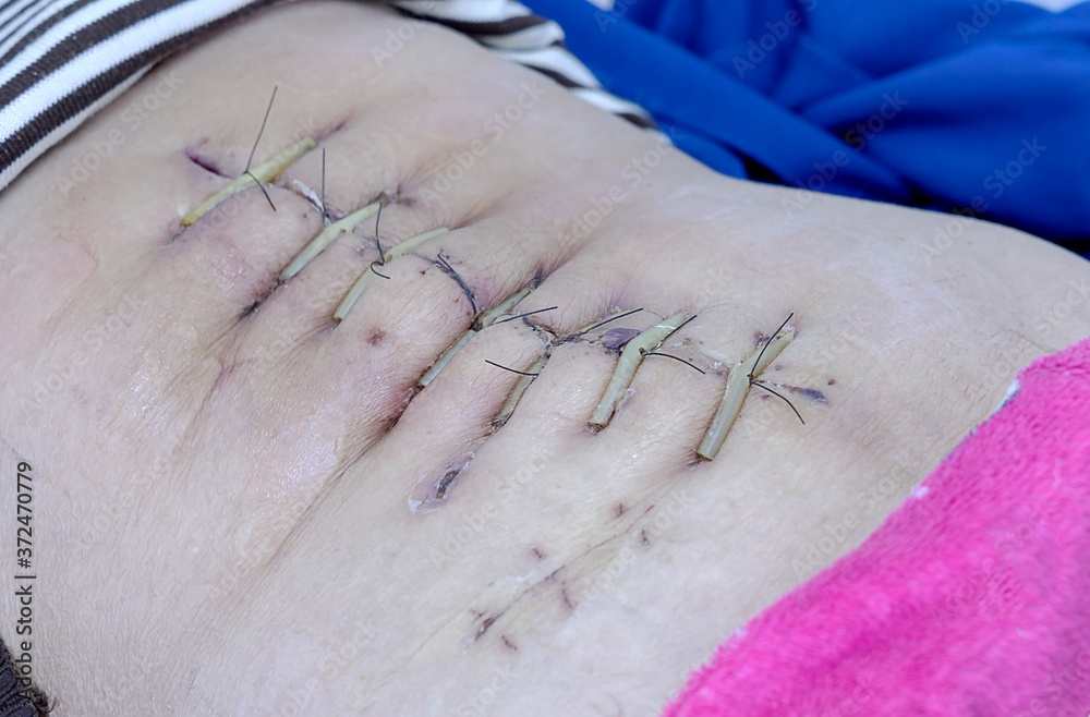 Obraz premium abdominal surgering wound