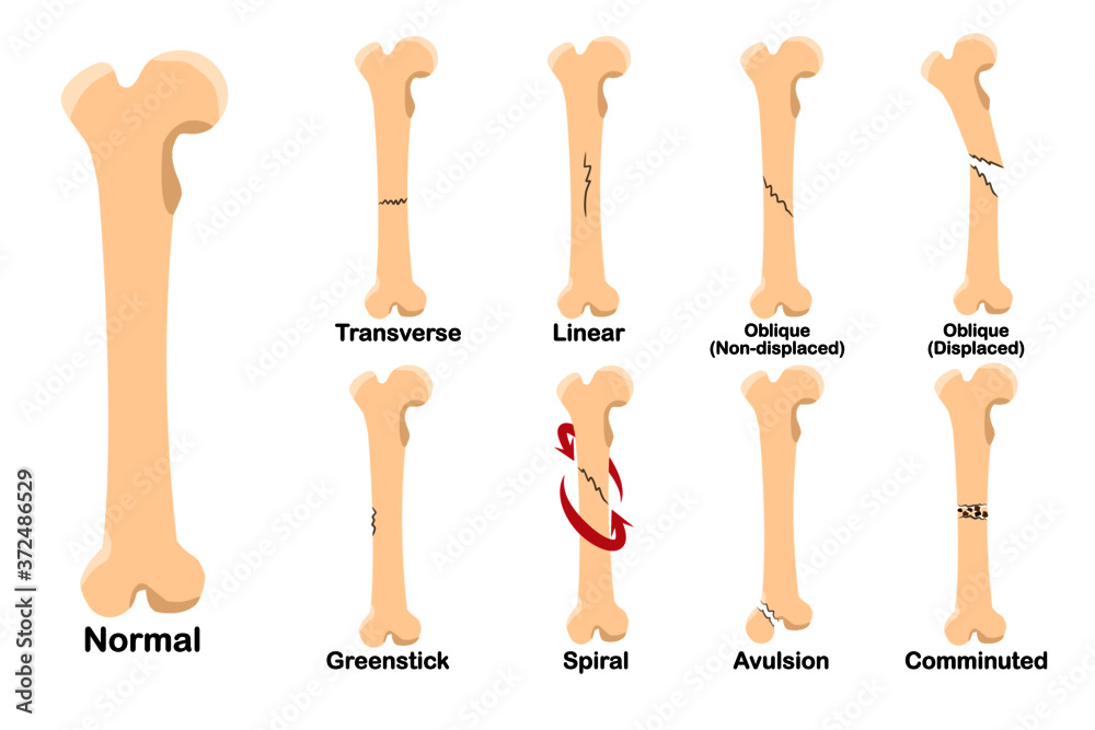 Types Of Fracture Include Trasverse Linear Oblique Non Displaced Oblique Displaced Spiral