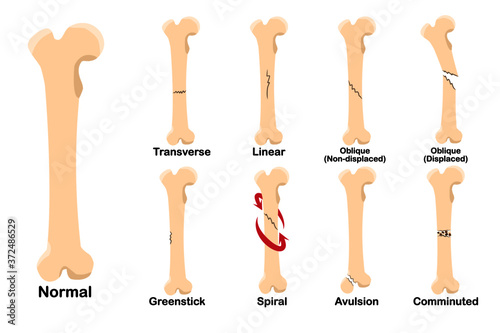 Types of fracture include Trasverse, Linear, Oblique(Non-displaced), Oblique(Displaced), Spiral, Greenstick, Comminuted, and Avulsion.  