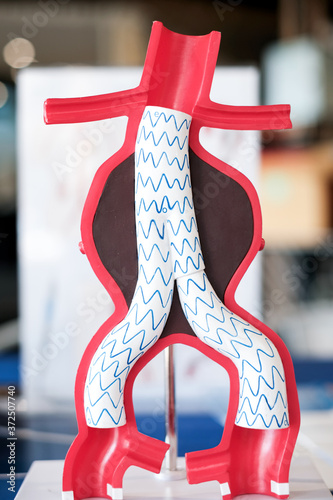 focus at a model of endovascular aneurysm repair (evar) for people education