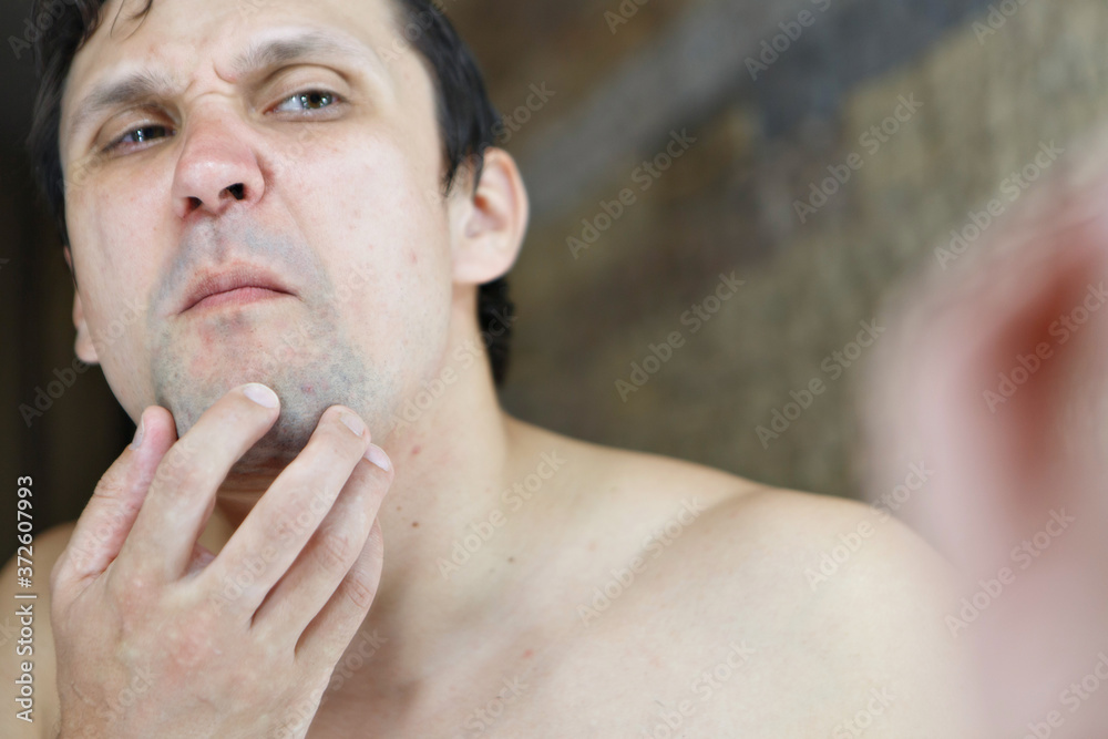 Fototapeta premium the man squeezes out a pimple on his face. the guy looks in the mirror. morning treatments in the bathroom. copyspace