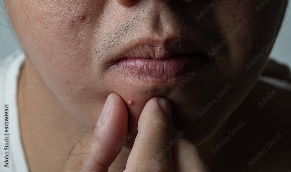 Obraz premium press acne on face, skin problem, scar and oily on face 