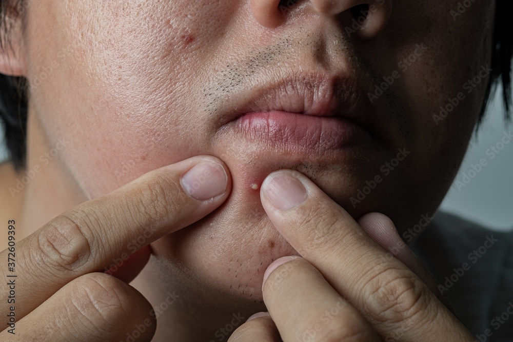 Fototapeta premium press acne on face, skin problem, scar and oily on face 