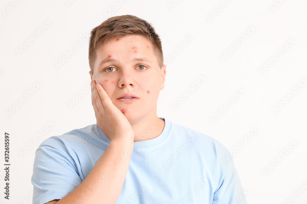 Teenage boy with acne on light background