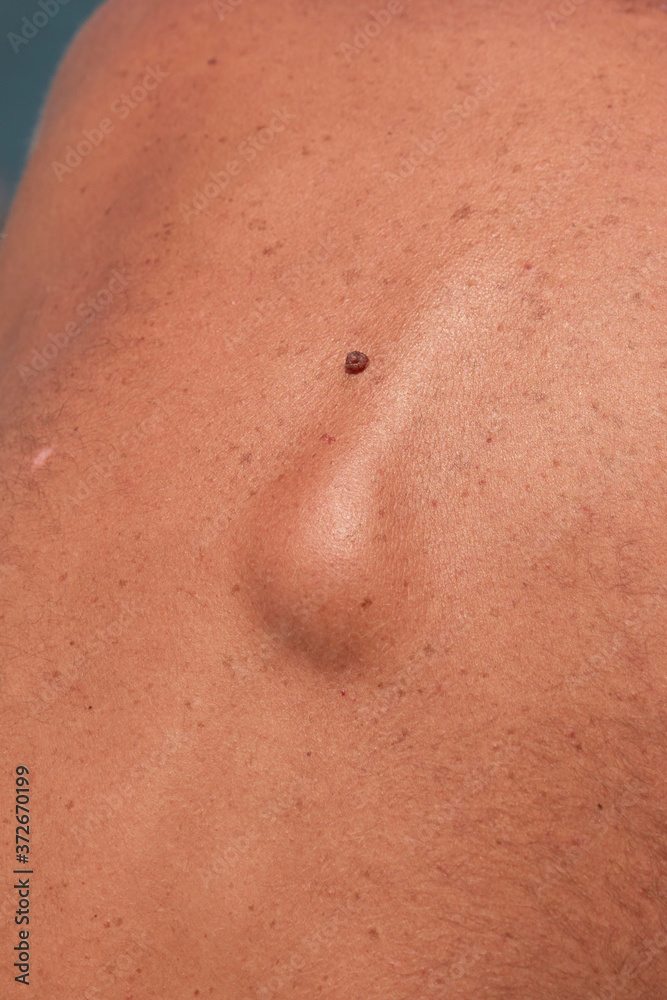 lump hernia on the skin of the back lump hernia on the skin of the back