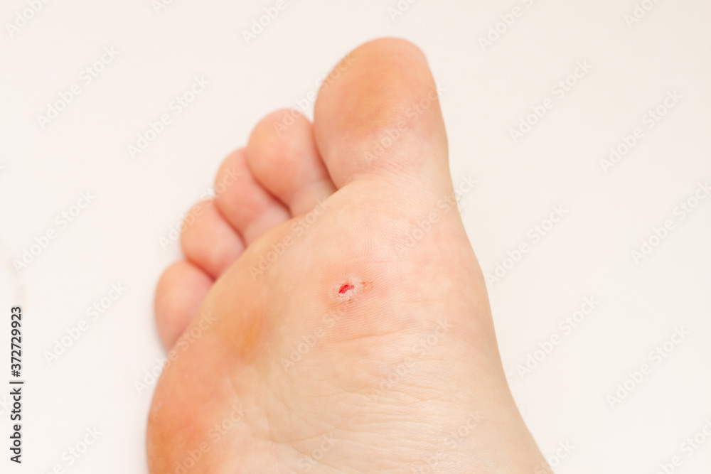 Plantar wart on foot. Open wound after wart removal on sole of foot