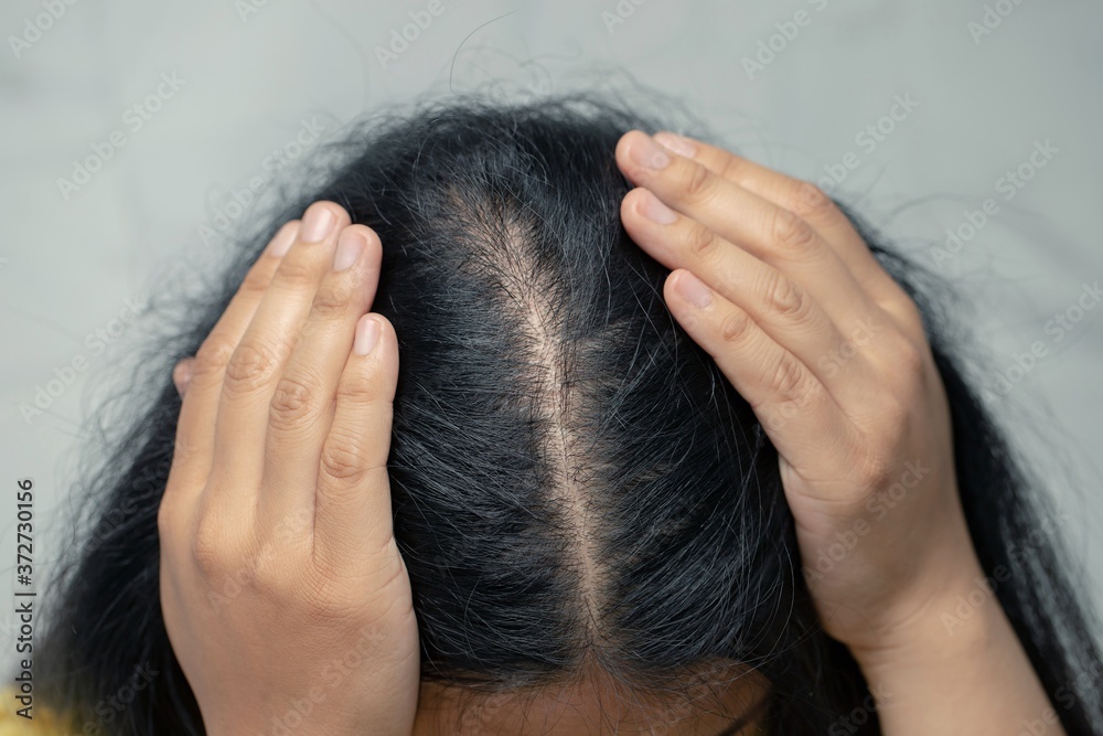 Fototapeta premium Bald woman hair loss from shampoo allergy