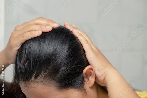 Bald woman hair loss from shampoo allergy