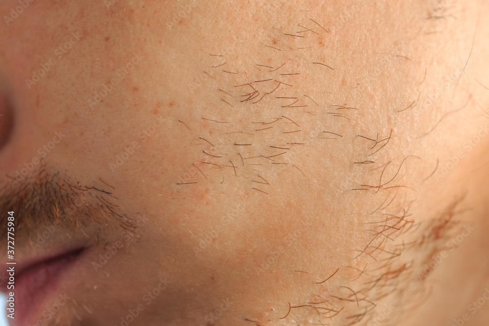 Fototapeta premium the problem of ungrown beard