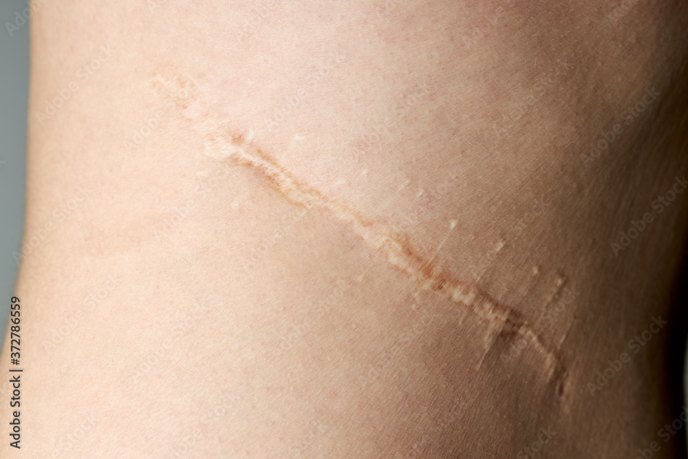surgery scar after kidney pyelonephritis. after remove kidney operation. caucasian person close up over gray background surgery scar after kidney pyelonephritis. after remove kidney operation. caucasian person close up over gray background
