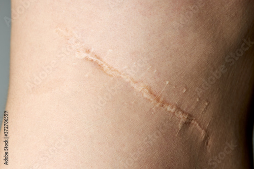 surgery scar after kidney pyelonephritis. after remove kidney operation. caucasian person close up over gray background