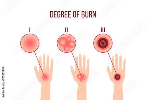 infographics of different degrees of burn
