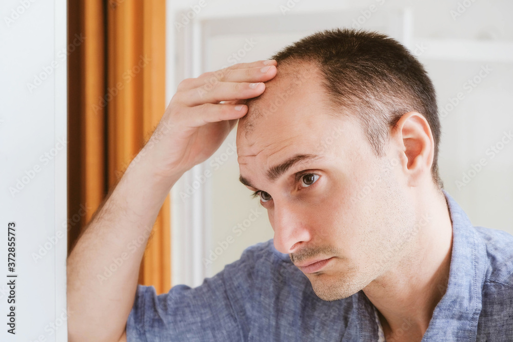 Young man looking at mirror worry about balding. Young man looking at mirror worry about balding.