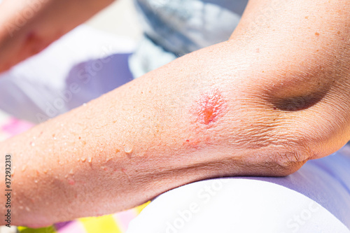 Swollen and infected red spot on woman's arm from a poison ivy rash and allergic reaction.
