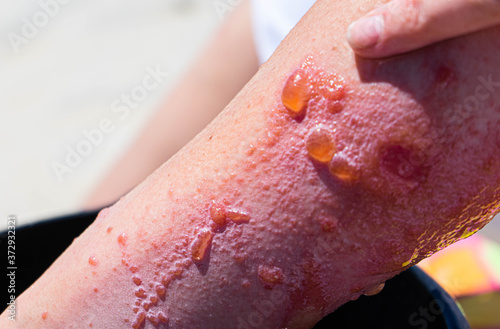 Pointing at severe allergic reaction to poison ivy on a woman's arm. Blisters, swollen redness, and oozing from poison ivy skin reaction.