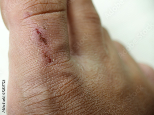 closeup abrasion wound on toe skin