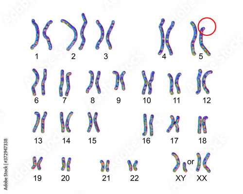 Obraz na płótnie Karyotype of Cri du chat, or cat's cry, syndrome, also known as 5p- syndrome