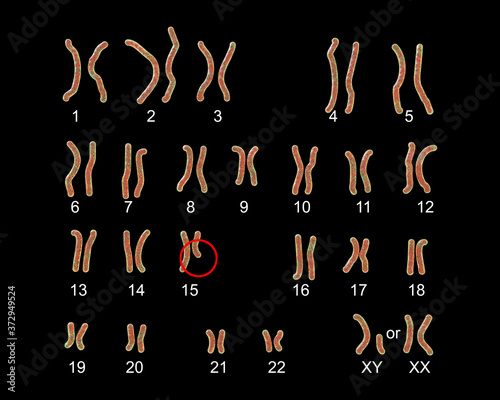 Karyotype of Prader-Willi syndrome photo